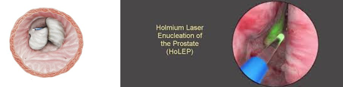 HOLEP BPH Therapy