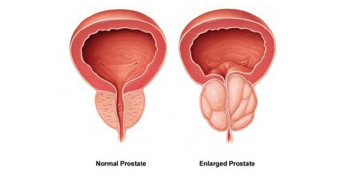 Prostate BPH