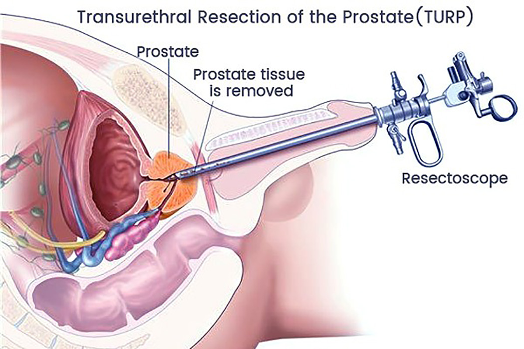 Prostate BPH