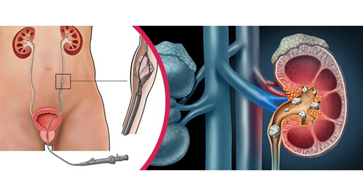 Ureteroscopic Lithotripsy (URSL)